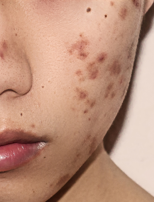 Unterirdische Pickel: Die schmerzhafte Plage im Gesicht