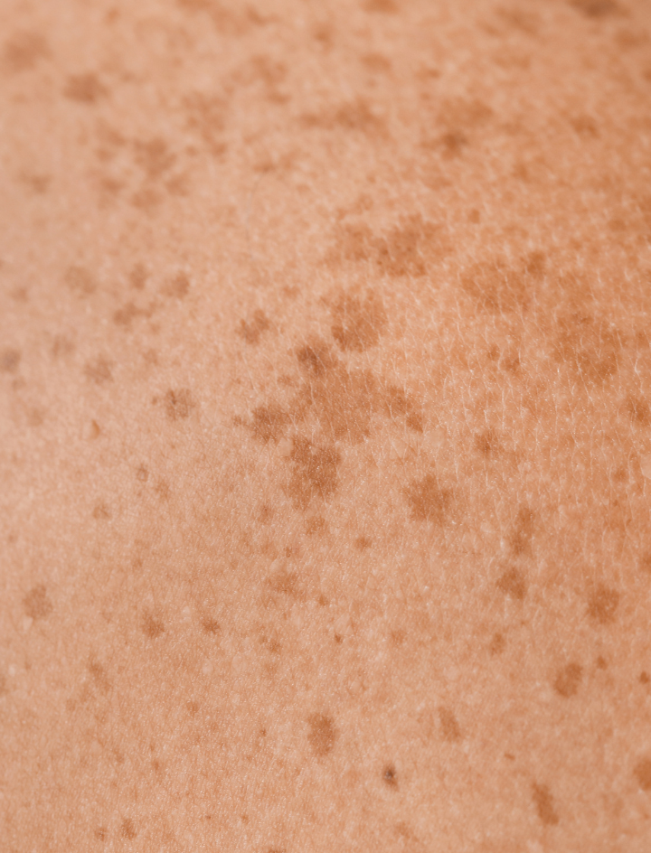 Pigmentflecken nach dem Sommer: sanft ausgleichen und vorbeugen