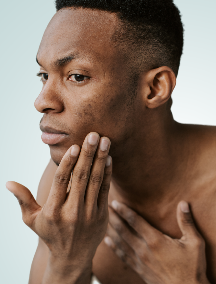 Winterakne: Die besten Tipps zur Heilung der Haut